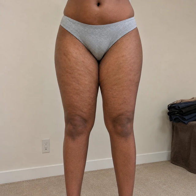 Day 15, hip, after
