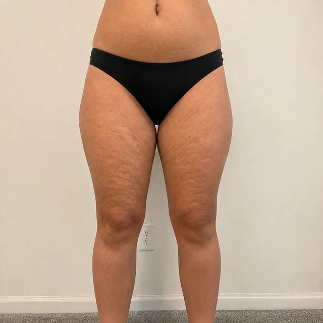 Day 1, thighs, before
